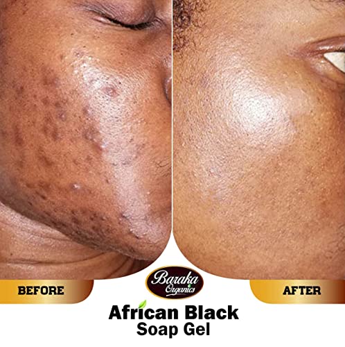 BarakaCreations Африкански черен сапун-гел с рициново масло, не, изгаряния, акне, кожни обриви, хиперпигментация, всички дефекти на кожата. Дълбоко хидратиращ крем - За Чувс
